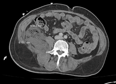 Gluteal abscess seeded by extension of psoas abscess via sciatic fistulization