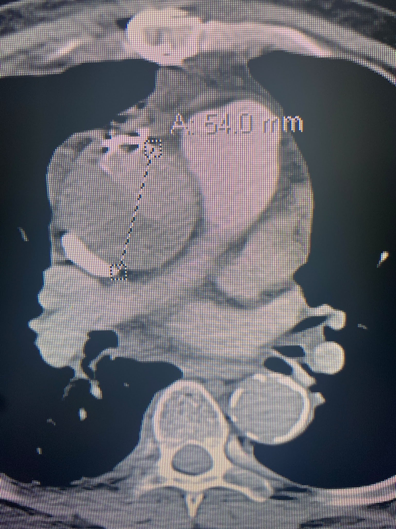 Altered Mental Status in a Patient with an Acute Aortic Dissection